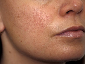 Koldioxidlaser acneärr före operation