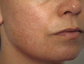 Koldioxidlaser acneärr 6 månader efter behandling