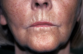 Koldioxidlaser runt munnen före
