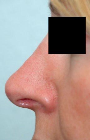Öppen näsplastik ändring av nästipp 6 månader efter behandling