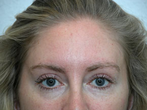 Pannlyft med titthålsteknik och övre ögonlocksplastik 6 månader efter